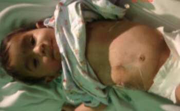Traitement des infections urinaires chez les enfants à Delhi